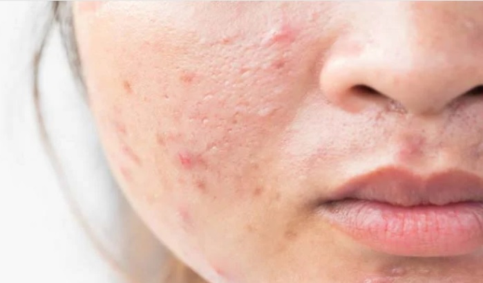 ব্রণের দাগ দূর করুন ঘরোয়া উপায়ে