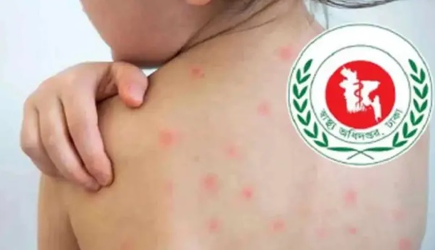 হাম উপসর্গে আরো ৬ শিশুর মৃত্যু